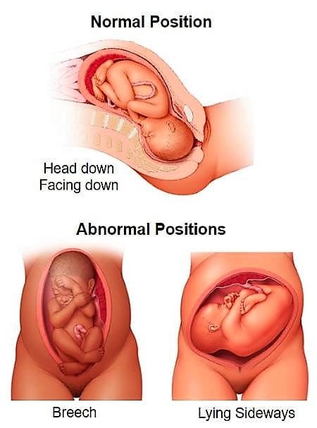normal vaginal delivery
