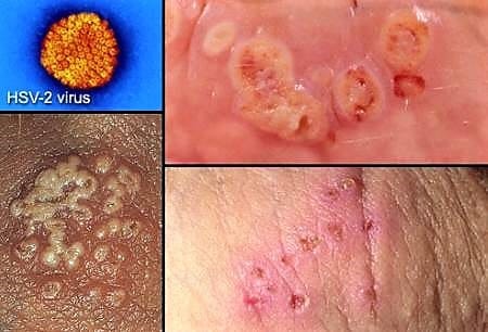std herpes, genital herpes, vaginal herpes