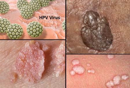 Genital Warts STD HPV, skin tag vs hpv , genital warts men , genital warts vs skin tags