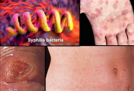 syphilis symptoms pictures women