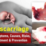 miscarriage symptoms, risk, types, causes, pictures, at 6-14 weeks